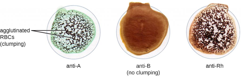 Three wells the first well (labeled anti-A) shows black spots and is labeled clumping. This is due to the agglutinated RBCs. The second well (labeled anti-B) looks smooth and has no clumping. The third well (labeled) anti-Rh shows clumping because it has spots.