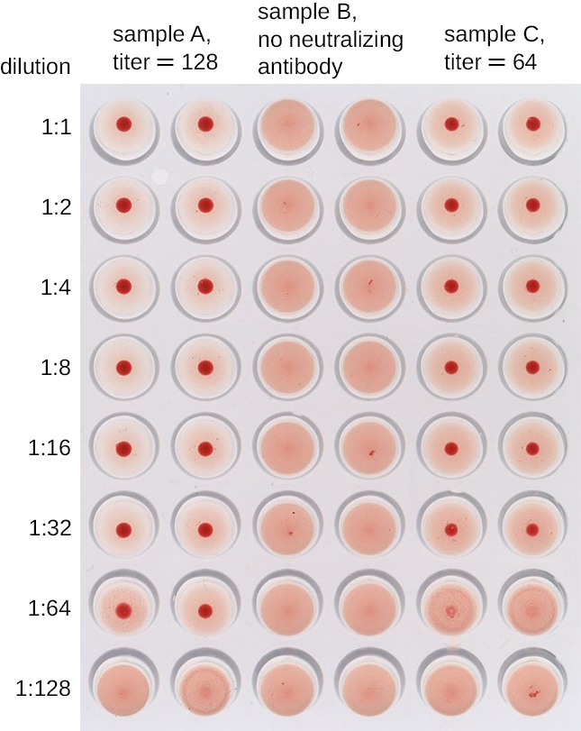 A drawing of a well plate. The label at the top reads: Dilution. The rows are labeled: 1:1, 1:2, 1:4, 1:8, 1:16, 1:32, 1:64, 1:128. The columns are labeled: Sample A, titre = 128 (this spans columns 1 and 2). Sample B, no neutralizing antibody (spans columns 3 and 4). Sample C, titre = 64 spans columns 5 and 6.). Columns 1 and 2 have red dots in all rows but the bottom one. Columns 3 and 4 have no red dots. Columns 5 and 6 have red dots in all rows but the bottom two.