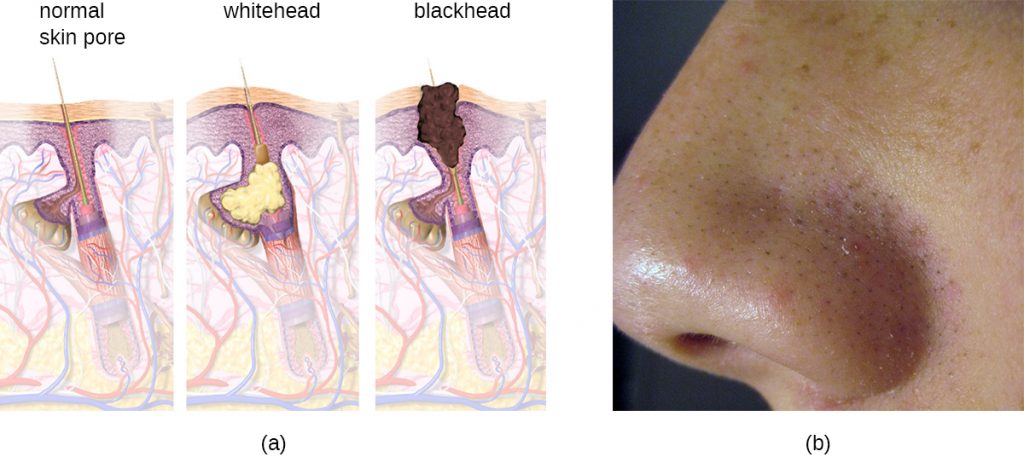 a) diagram of blackhead formation. A normal pore in the skin becomes filled with material forming a whitehead. Darker material forms a blackhead. B) blackheads on a nose.