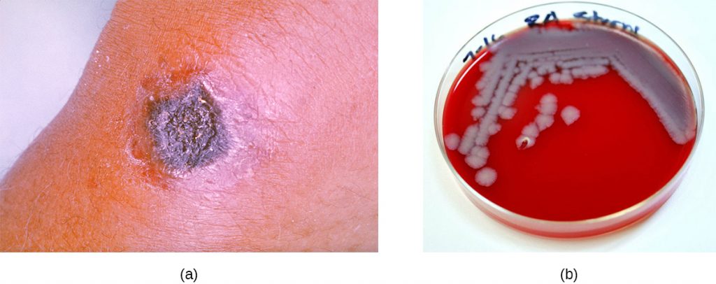 a) A black nodule on skin. b) A red plate with grey colonies.