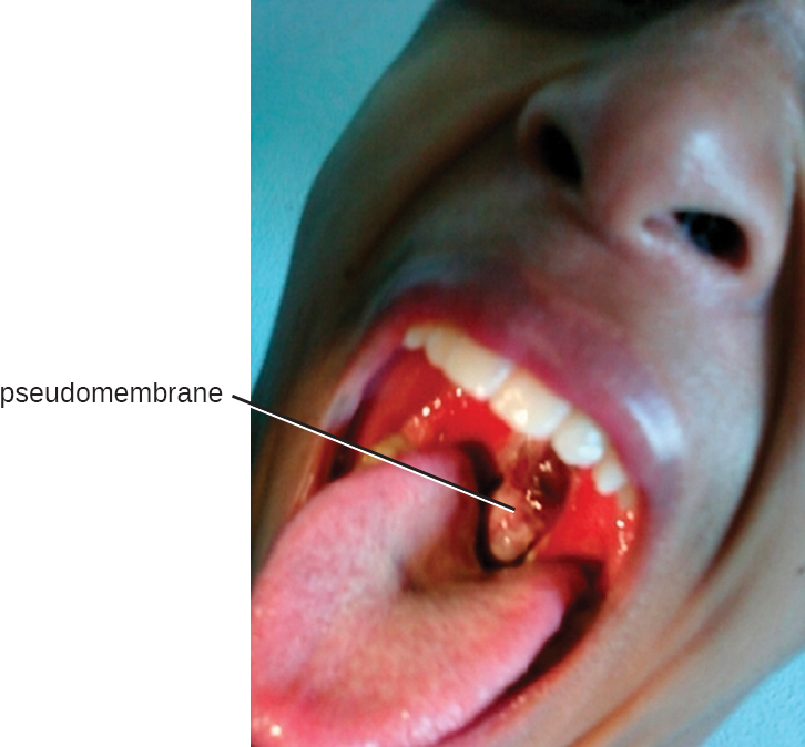 A grey, leathery blob in the back of a person’s mouth is shown and the label “pseudomembrane” points to it.