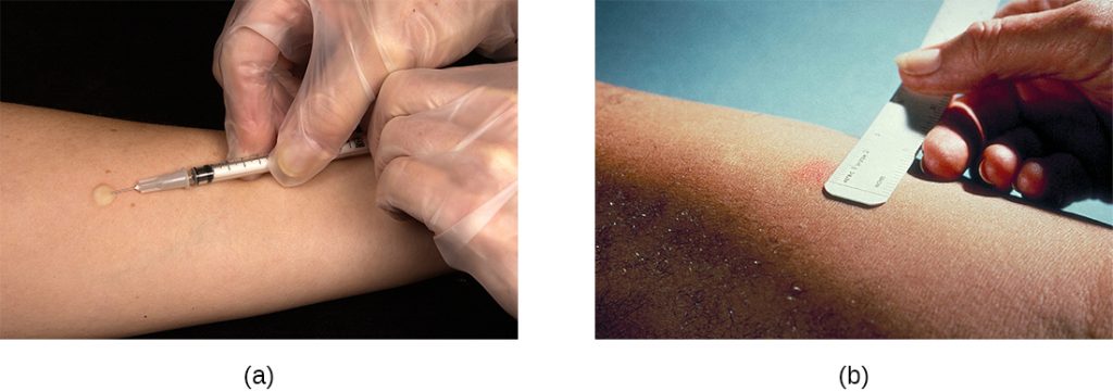 a) a needle injects a small drop into a person’s skin. B) a ruler is used to measure a red area on a person’s skin.
