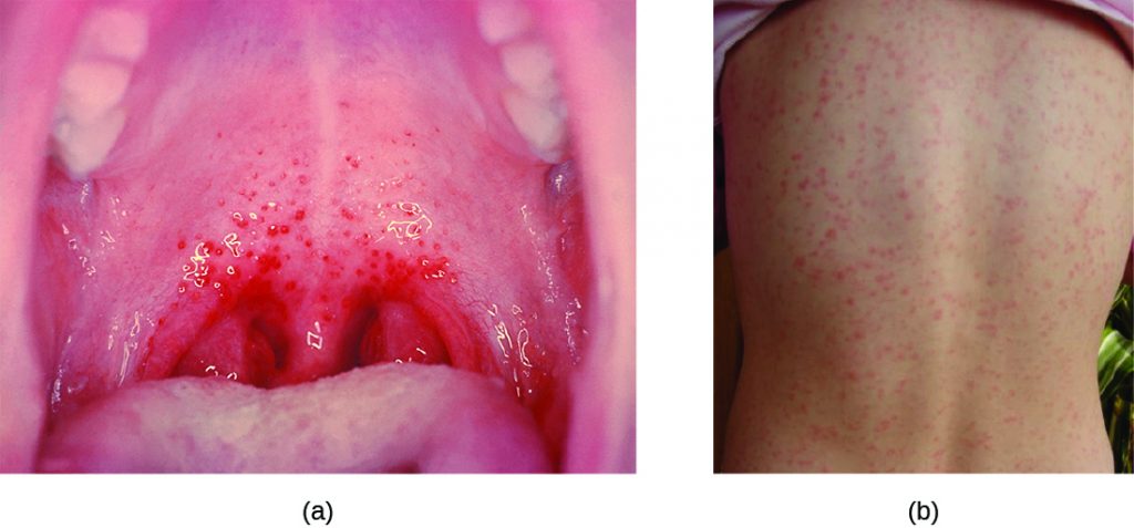a) photo of person with bright red inflammation at the back of the mouth, indicative of strep throat. b) Photo of a person with a red rash covering the back as a result of scarlet fever