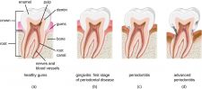 25.2 Microbial Diseases of the Mouth and Oral Cavity – Microbiology ...