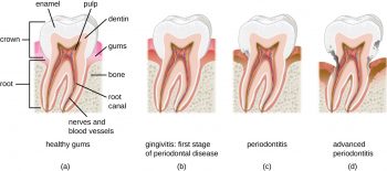 25.2 Microbial Diseases Of The Mouth And Oral Cavity – Microbiology 