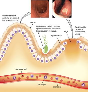 25.3 Bacterial Infections of the Gastrointestinal Tract – Microbiology ...