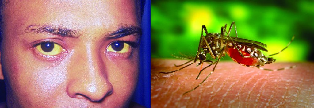 Photo of a person with yellow eyes. Photo of a mosquito on an arm.