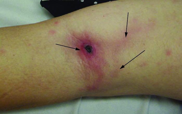 An arm with a dark red spot on the elbow with red lines emanating from it under the skin.