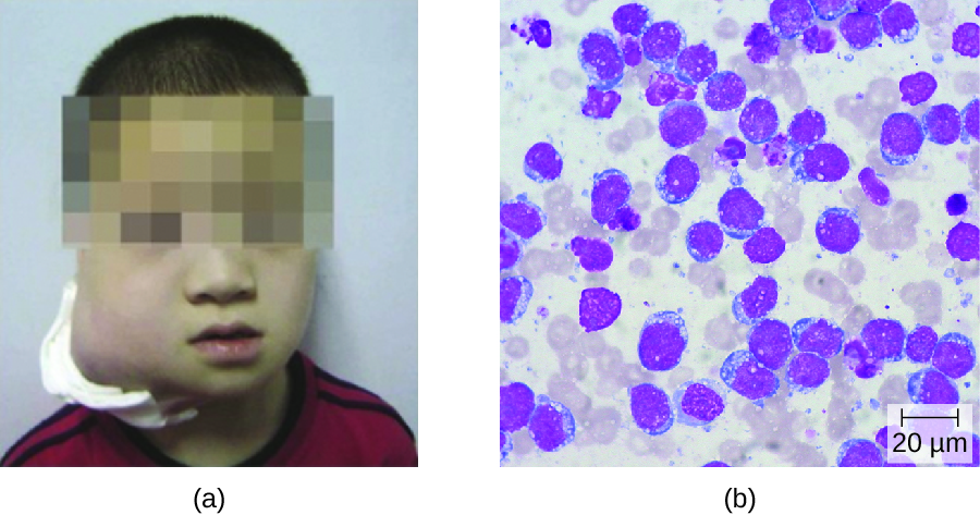 a) photo of a child with a very large swelling on the side of the neck. B) micrograph of a blood smear with a lot of white blood cells that are oddly shaped with white spots.