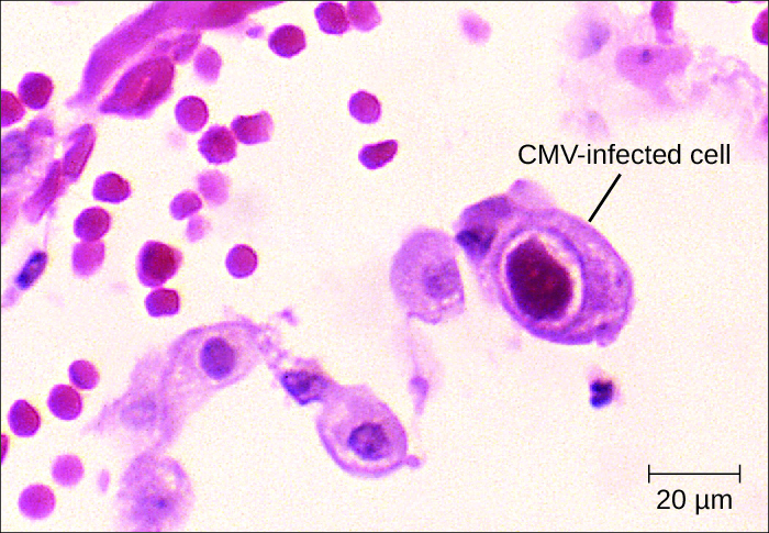Micrograph of cells. A large one with a large, dark nucleus is labeled CMV-infected cell.