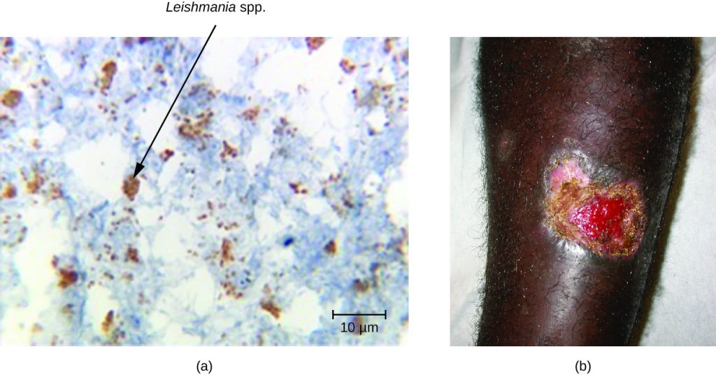 a) Micrograph of a tissue sample. A black arrow points to leishmania mexicana. B) a large, open wound on skin.