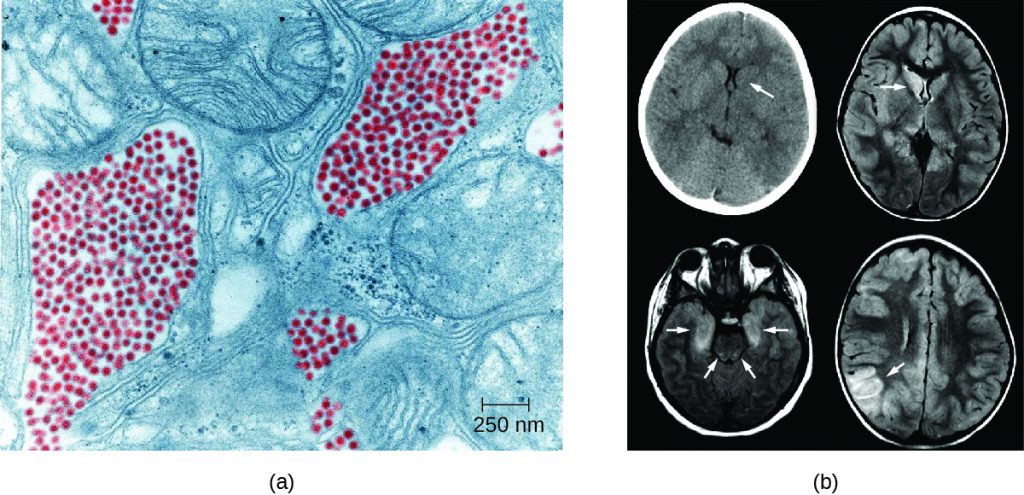 a) electron micrograph showing small red viral particles next to larger cellular structures. B) brain scans with arrows pointing to dark regions in the brain.