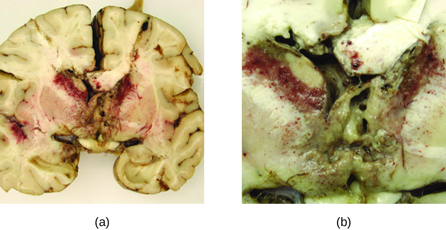 a) Photo of brain section with red granules in the centre. b) close-up of granules.