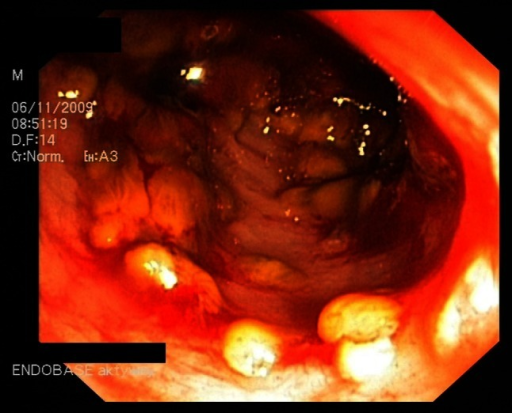 Photograph from a colonoscopy of a patient with pseudomembranous colitis. Yellow plaques are characteristic of the disease and are ulcerations of the colon mucosal epithelium