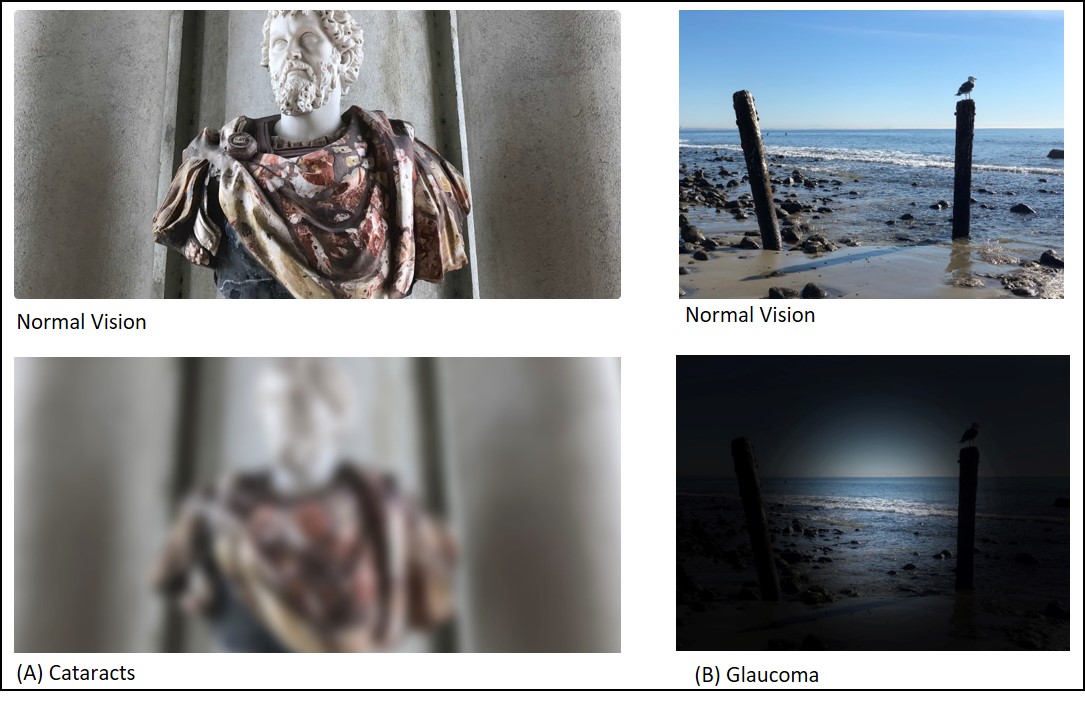 The effect of cataracts on vision is demonstrated by showing a clear image of a statue (normal vision) and the same image which appears blurry (cataracts). The effect of glaucoma on vision is demonstrated by showing a clear image looking over a beach into the ocean (normal vision) and the same image which is appears dark around the outside so only the center of the image is clear.