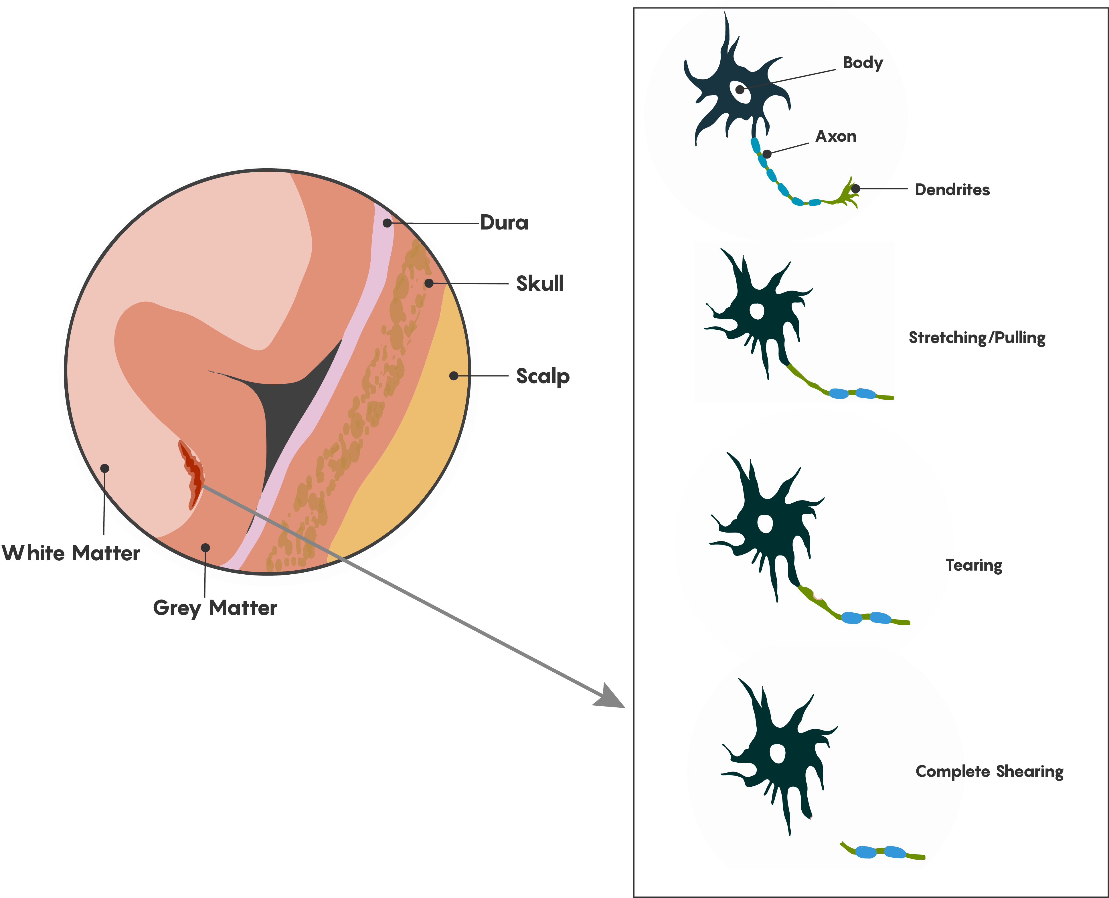 Diagrama esquemático de la lesión axonal difusa después de TBI/conmoción cerebral.