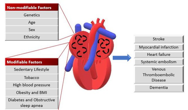 An illustration of the causes and effects of atrial fibrillation. The causes include non-modifiable factors, such as genetics, age, sex, and ethnicity; and modifiable factors like sedentary lifestyle, tobacco use, high blood pressure, obesity, diabetes and obstructive sleep apnea. Untreated atrial fibrillation can lead to stroke, myocardial infarction, heart failure, systemic embolism, Venous Thromboembolic Disease, and dementia.