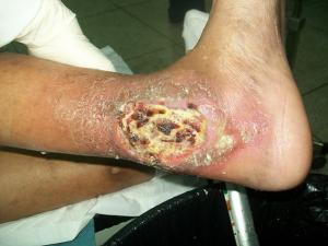 Example of a diabetic foot ulcer