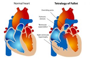 The heart of an individual with Tetralogy of Fallot has several differences from a normal heart, including: overriding aorta, pulmonic stenosis, right ventricular hypertrophy, and a ventricular septal defect.