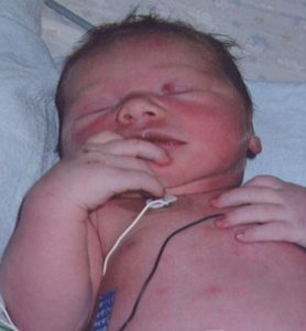 A photograph of a newborn with Down Syndrome.