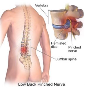 An illustration of a pinched nerve and herniated disc in the lower back.