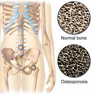 An illustration comparing normal bone to bone with osteoporosis, which is more porous and fragile.