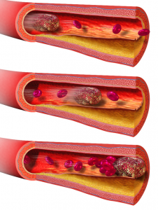 An illustration of the formation of a blood clot.