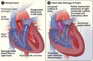 The heart of an individual with Tetralogy of Fallot has several differences from a normal heart, including: increased outflow in aorta; partial obstruction of right ventricular outflow to lungs and pulmonary valve; ventricular septal defect; and thickened right ventricle.