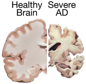 A healthy brain on the left, versus a brain with severe Alzheimer's Disease on the right