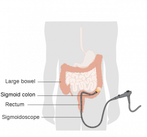 An illustration of a sigmoidoscopy, in which a sigmoidoscope is inserted into the rectum in order to view colon tissue.