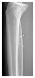 An xray image of a fractured leg bone.