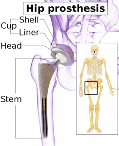 An illustration of a hip prosthesis that may be installed after a fracture.