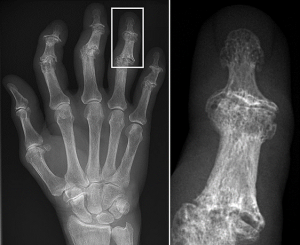 An xray image of a right hand.