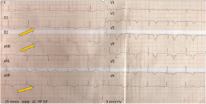 ECG shows T inversion (yellow arrows) in lead II, III, and aVF1.