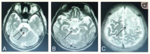 High signal intensity lesions on T2WI. Wilson disease in a 14-year-old girl with dystonia, with a diagnosis lag time 5 years (participant group >3 years) and abnormal signal in the pons (D), midbrain (E), and frontal and parietal lobes (F) (arrows).15