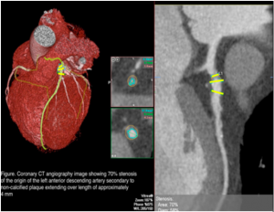 coronary computed tomography angiography images