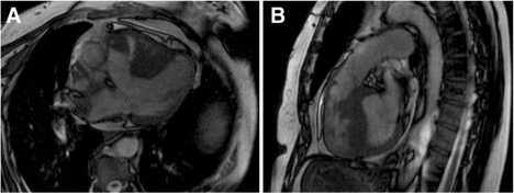 Cardiac magnetic resonance images