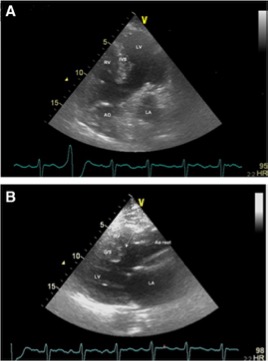 Echocardiography images