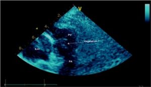 transthoracic echocardiogram