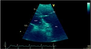 transthoracic echocardiogram images