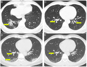 B and C- Chest CT showed multiple ground glass infiltrates (yellow arrows) in right lower lung field (admission day). D- Repeat chest CT displayed larger areas of ground glass opacities (yellow arrows) in both lower lung with a peripheral distribution (day 8). E- Repeat chest CT showed remission of lung lesions, with reduced density of ground glass opacities (day 17).