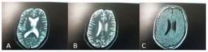 Brain magnetic resonance imaging with diffusion‑weighted imaging