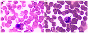 The peripheral blood smear showed a left shift of neutrophil nuclei, prominent toxic granulations and vacuolation in the neutrophil cytoplasm (see black arrows) (Wright stain ×1000).