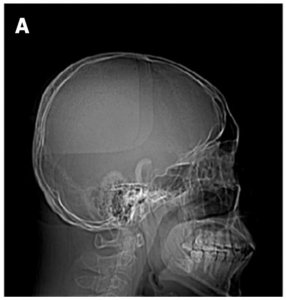 Head computed tomography (CT) scan.
