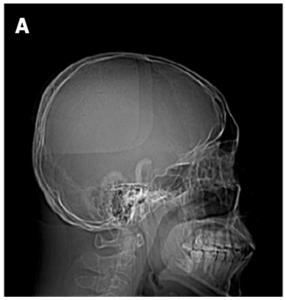 Second disease • LITFL • Medical Eponym Library