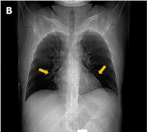 Multislice CT chest scan, showing little interstitial change (yellow arrows) in the lower lung.