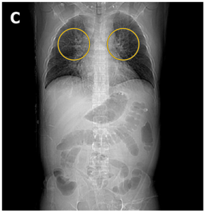 An abdominal CT scan suggested cardiac dysfunction with pulmonary edema. (Yellow circle showing batwing sign of pulmonary edema.)