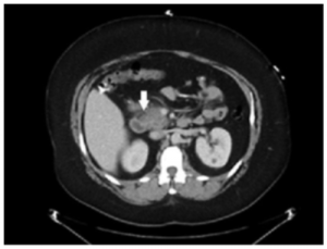 Abdominal CT image