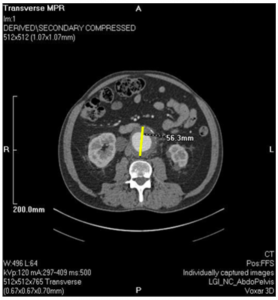 CT aortogram revealing the 5.6 cm (yellow line) anteroposterior diameter AAA.