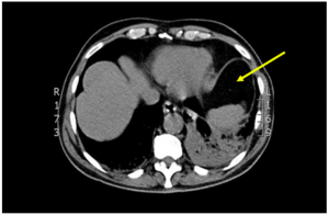 CT thorax shows the lower lobe consolidation and collapse in the left lung (yellow arrow) with extensive hilar lymphadenopathy.